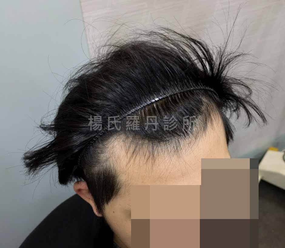 植髮 植髮手術