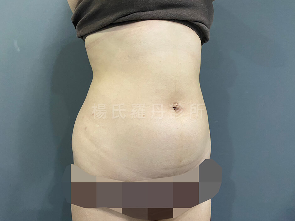 腹部環抽 抽脂