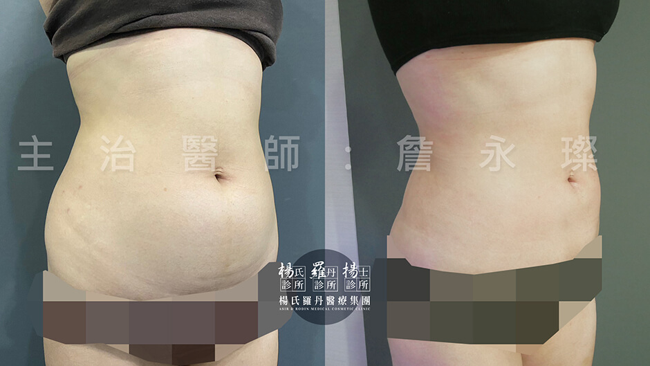 腹部環抽 抽脂 雷射減脂