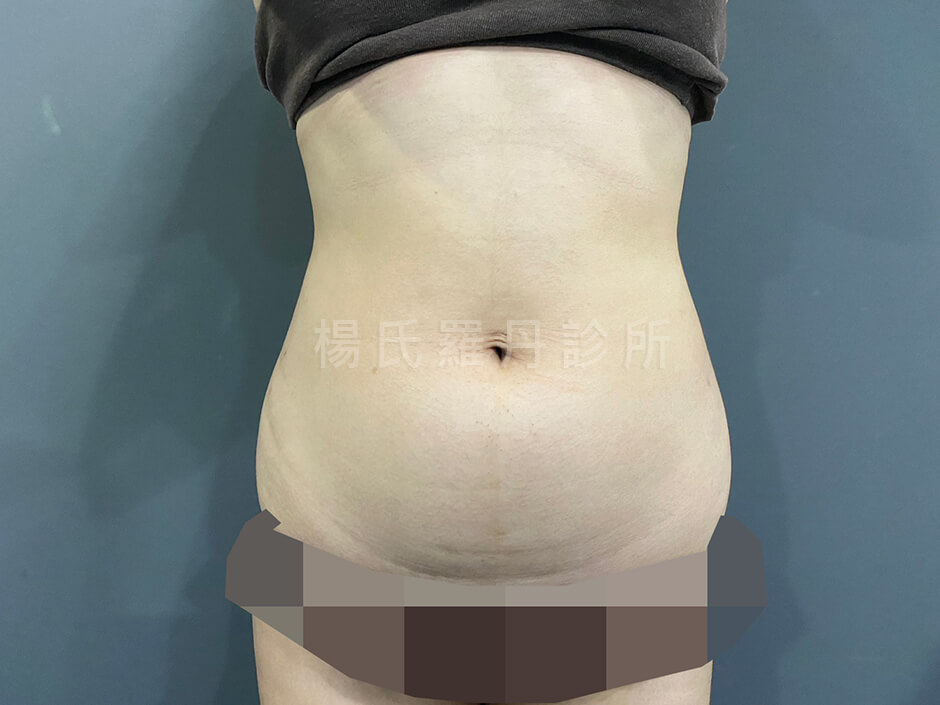減脂 雷射減脂 瘦小腹