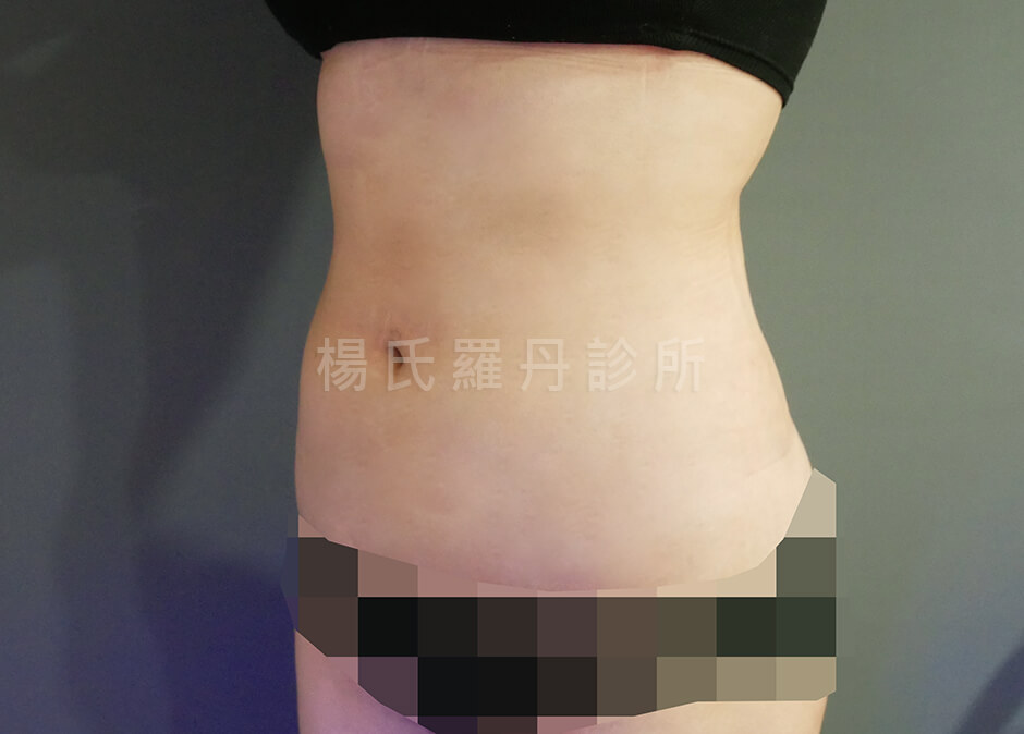 雷射減脂 瘦肚子