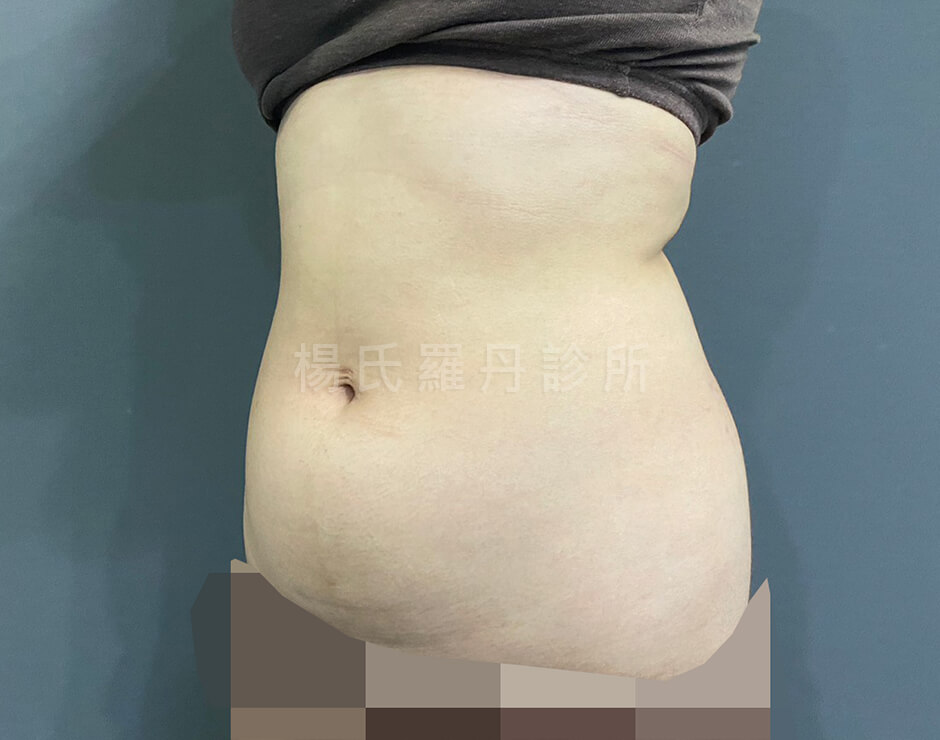 雷射減脂 瘦小腹