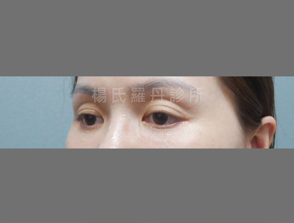 眼袋 眼袋消除 淚溝