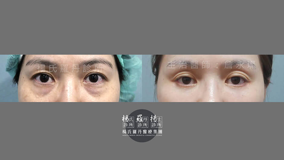 除眼袋 眼袋 淚溝