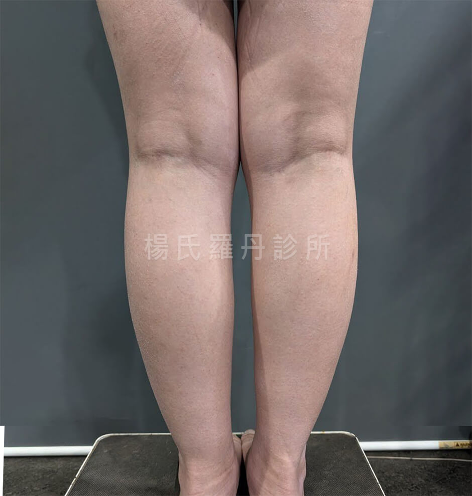 小腿抽脂 抽脂