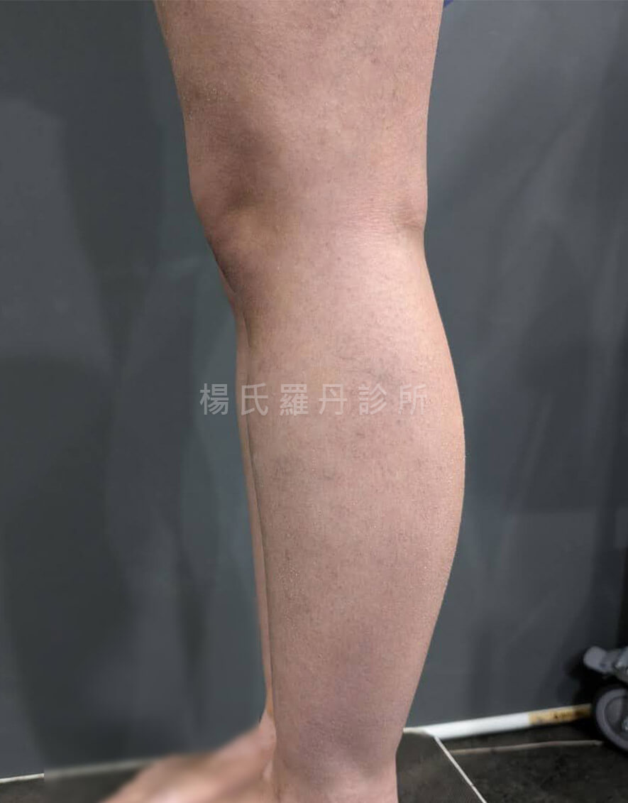 小腿抽脂 雕塑