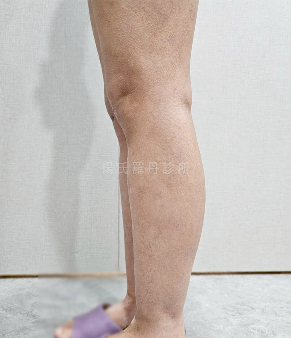 雷射減脂 瘦小腿