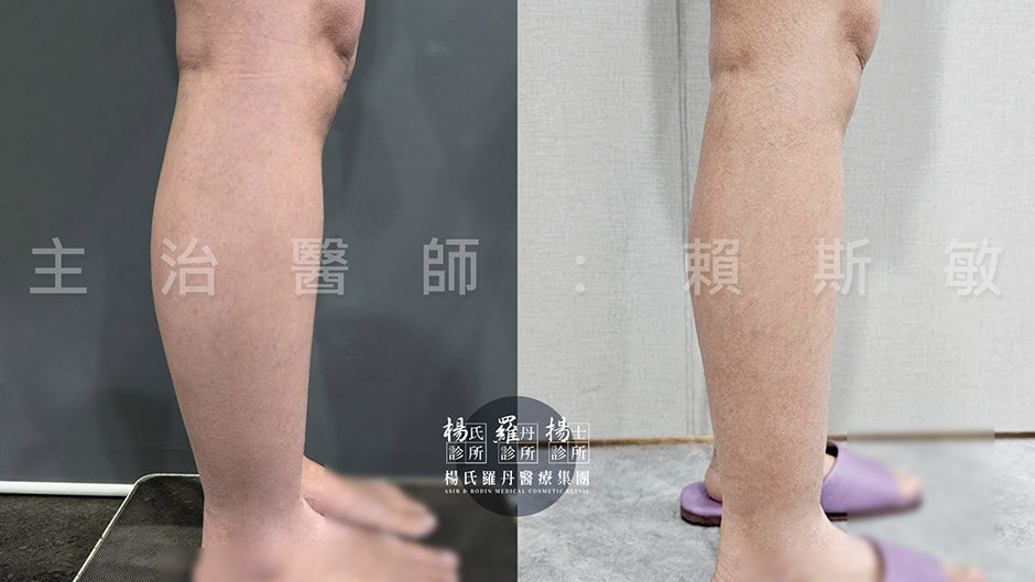 小腿抽脂 雷射減脂 瘦小腿