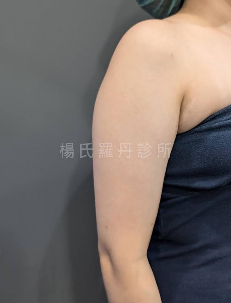 手臂抽脂 抽脂