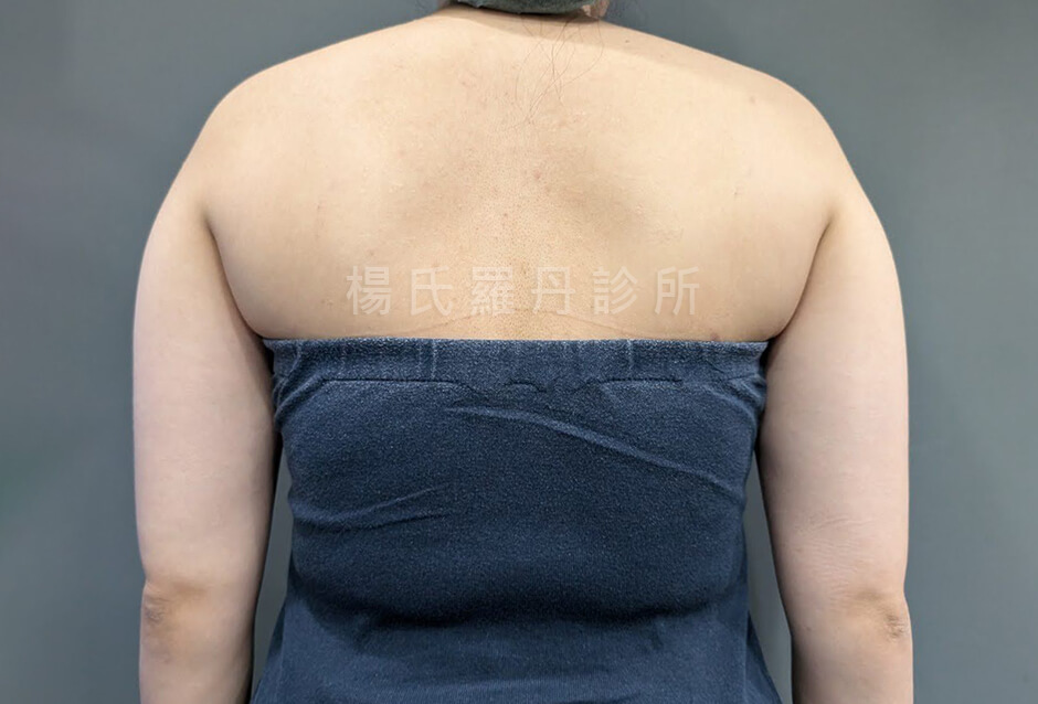 手臂抽脂 瘦手臂