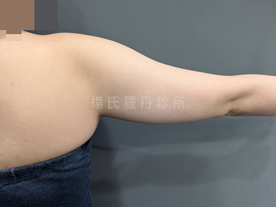 減脂手術 雷射減脂