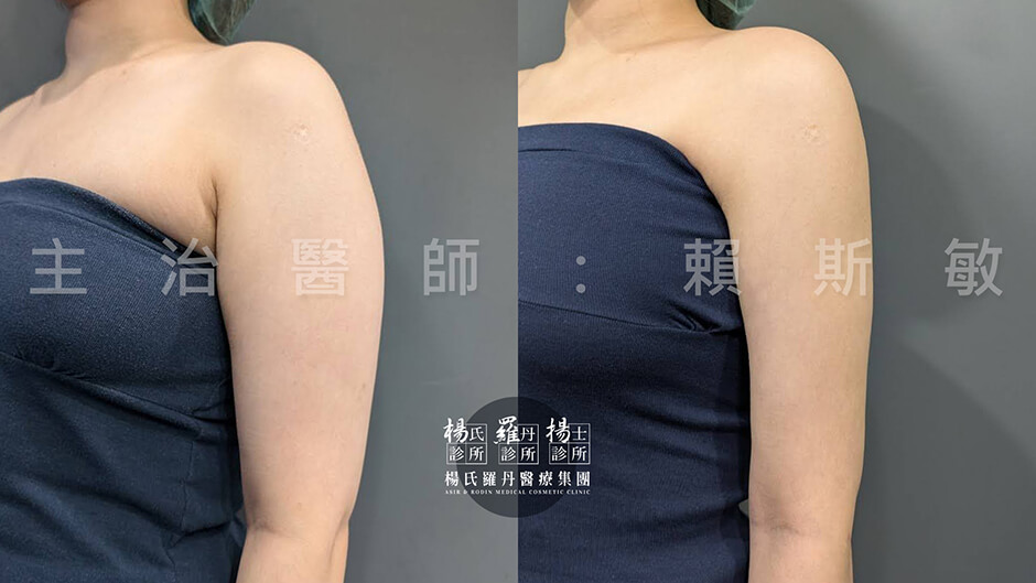 手臂抽脂 雷射減脂 抽脂