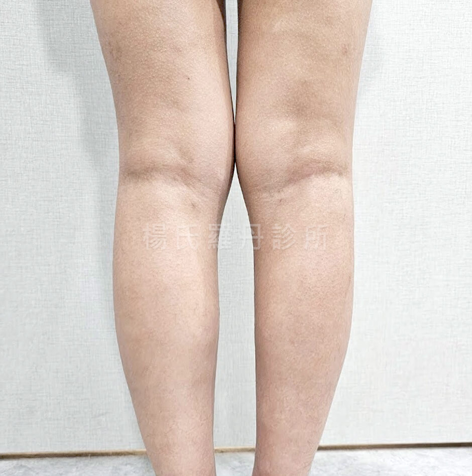 抽脂 小腿抽脂
