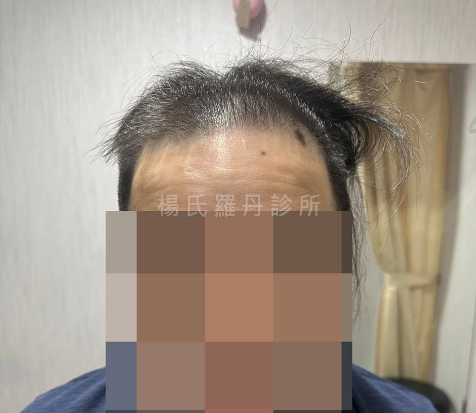 生髮治療 生髮 植髮