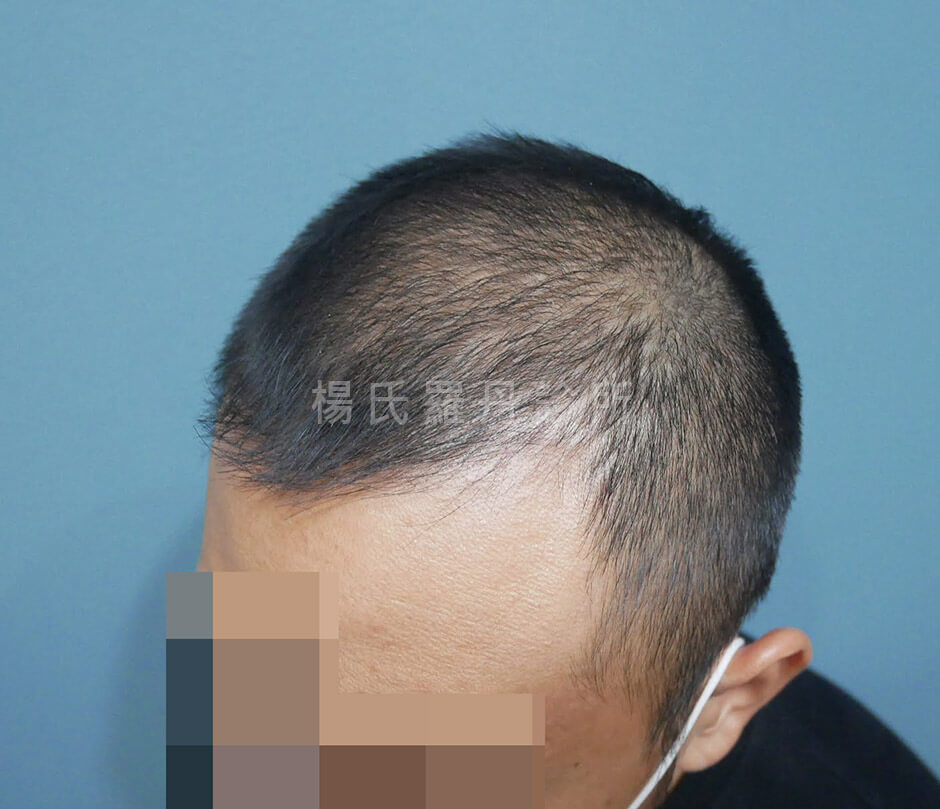 生髮 生髮效果