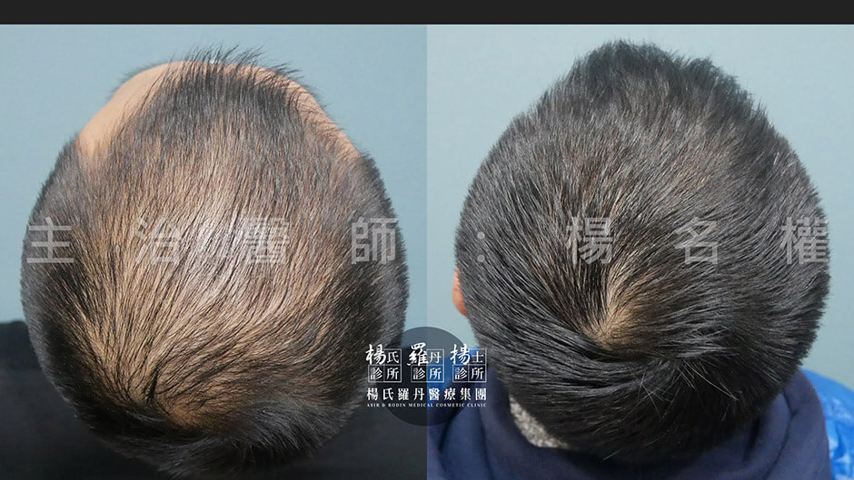 生髮 生髮治療 楊氏羅丹