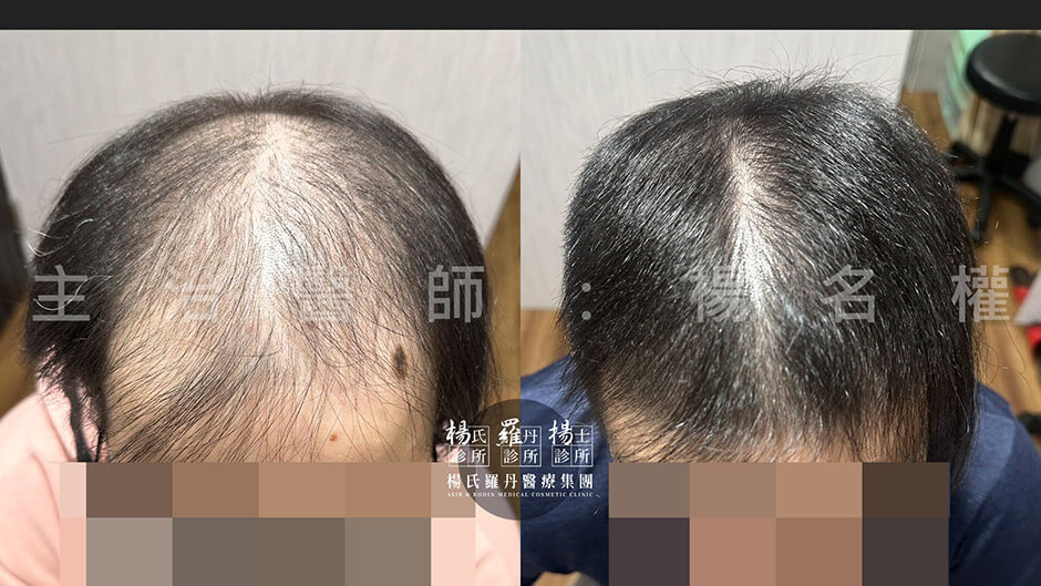 生髮 生髮治療 楊氏羅丹