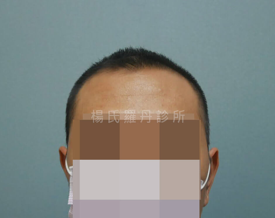 禿髮 生髮