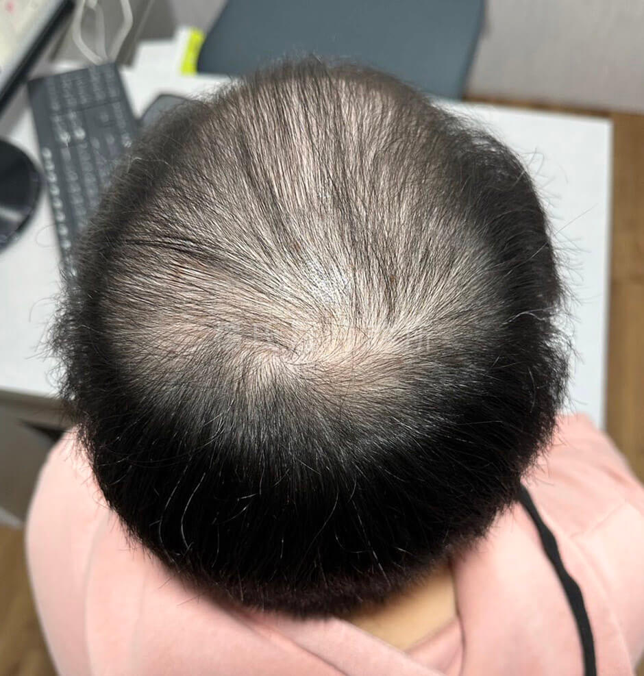 生髮 禿頭