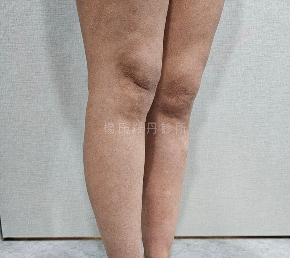 減脂 減脂手術 小腿抽脂