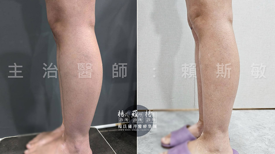 小腿抽脂 瘦小腿 雷射減脂
