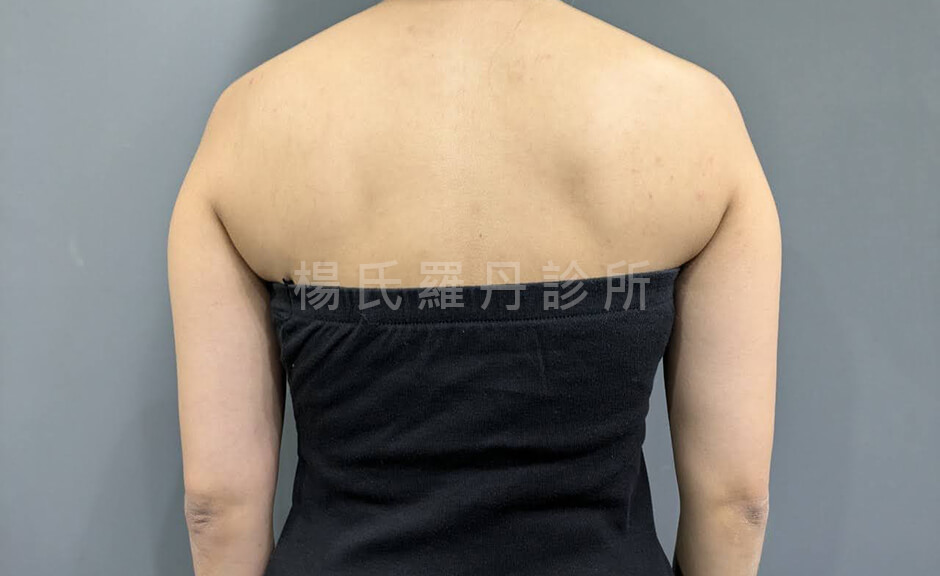 手臂抽脂 瘦手臂