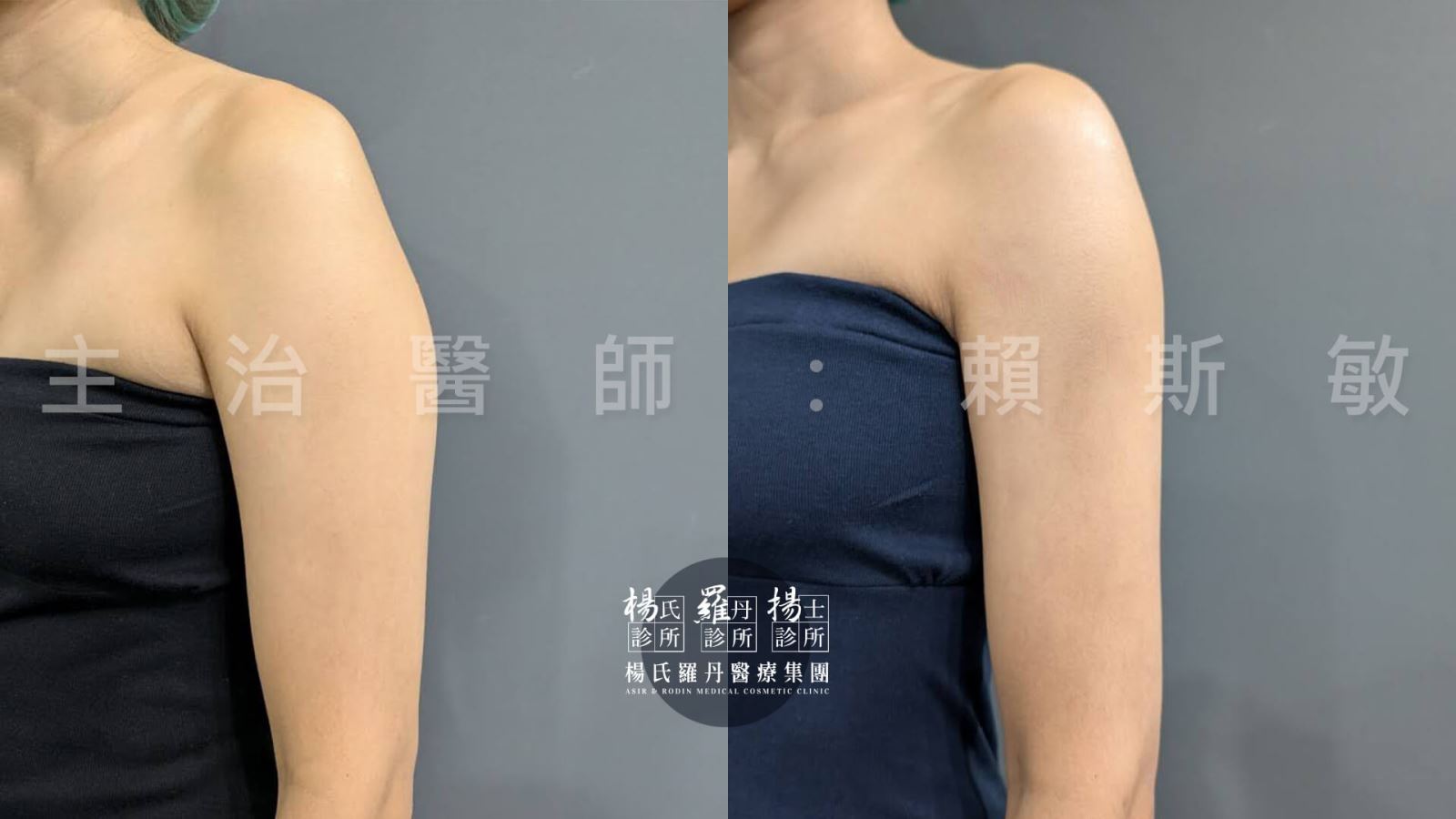 手臂抽脂 抽脂 瘦手臂