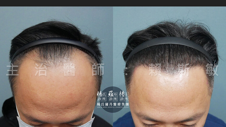 植髮 植髮效果 植髮手術