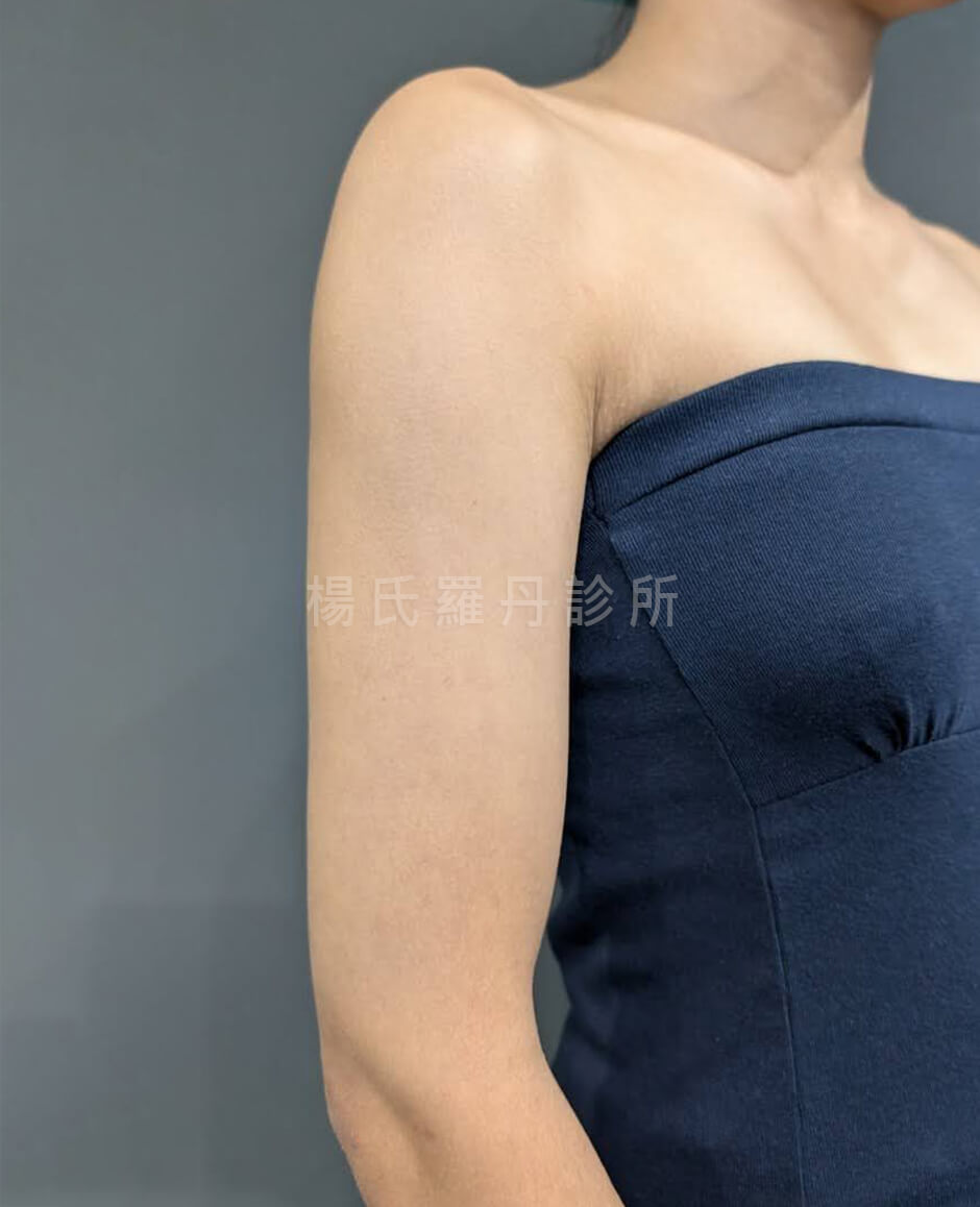 手臂抽脂 減脂 減脂手術
