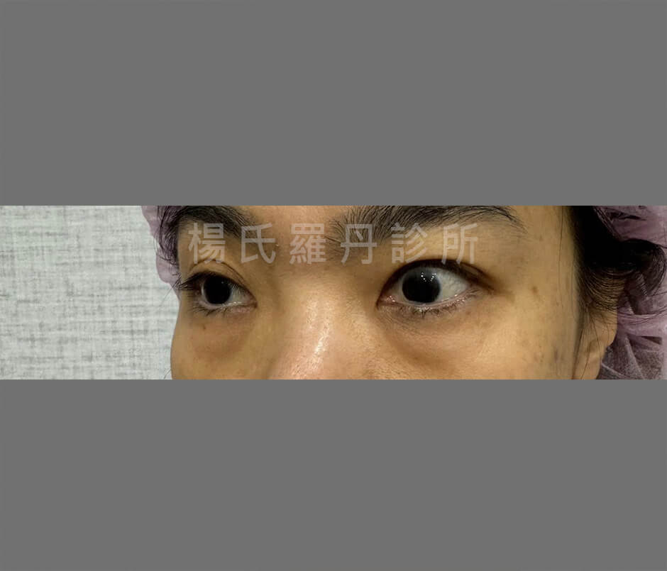 除眼袋 眼袋