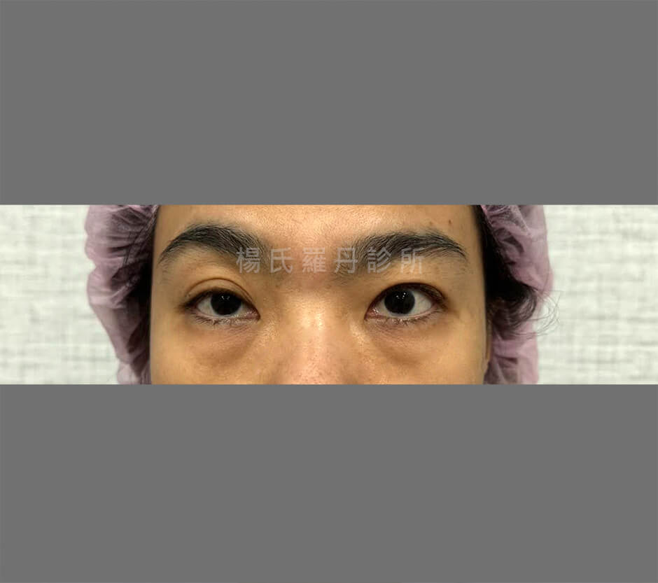 眼袋 除眼袋