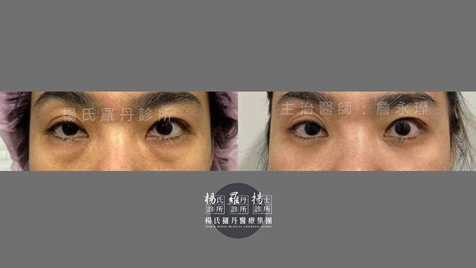 眼袋消除 除眼袋 眼袋