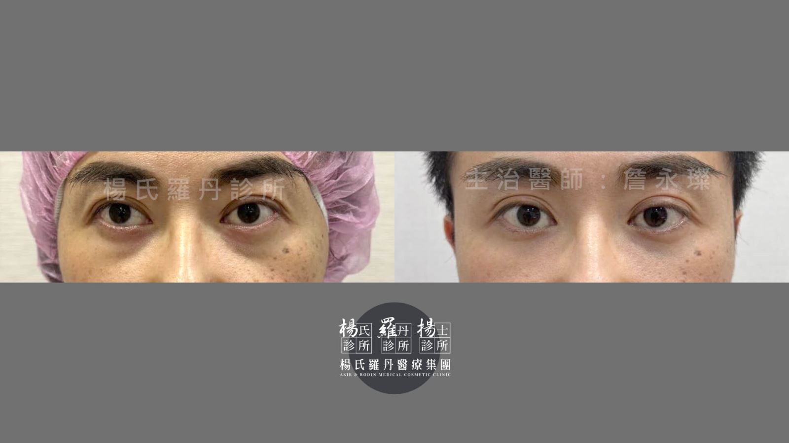 除眼袋 眼袋 淚溝