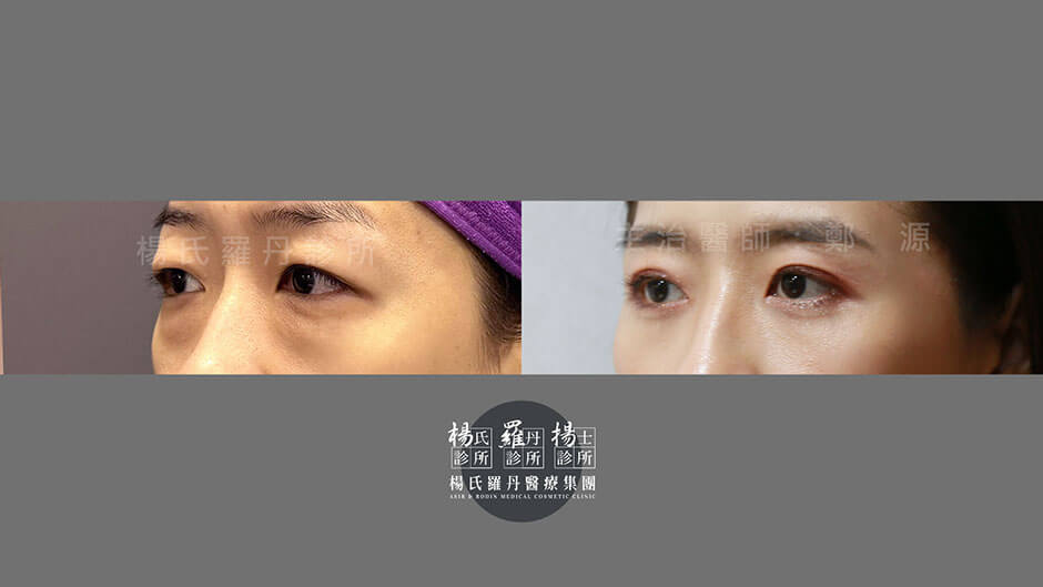 割雙眼皮 雙眼皮手術 泡泡眼
