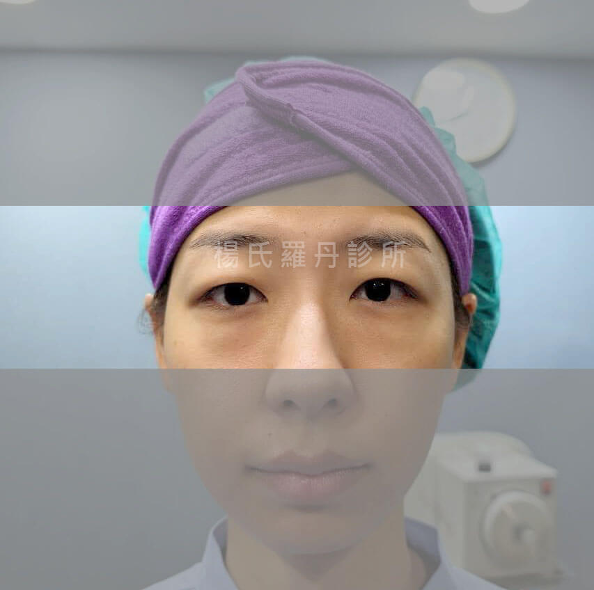 除眼袋 眼袋