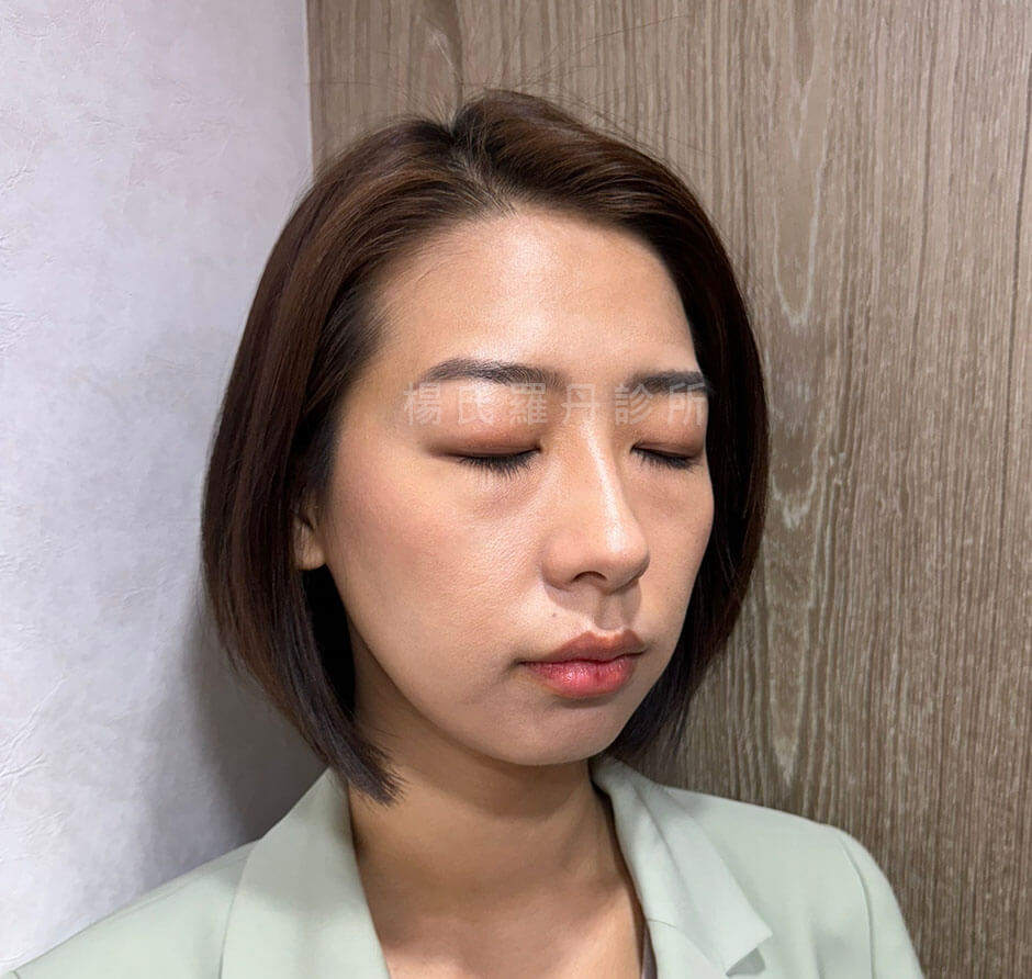 微創雙眼皮 雙眼皮