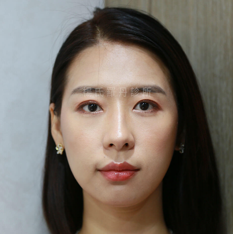 雙眼皮手術 雙眼皮