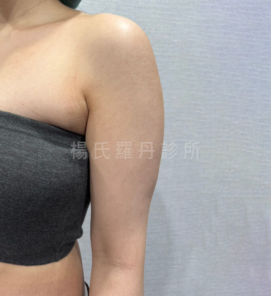 手臂抽脂 抽脂