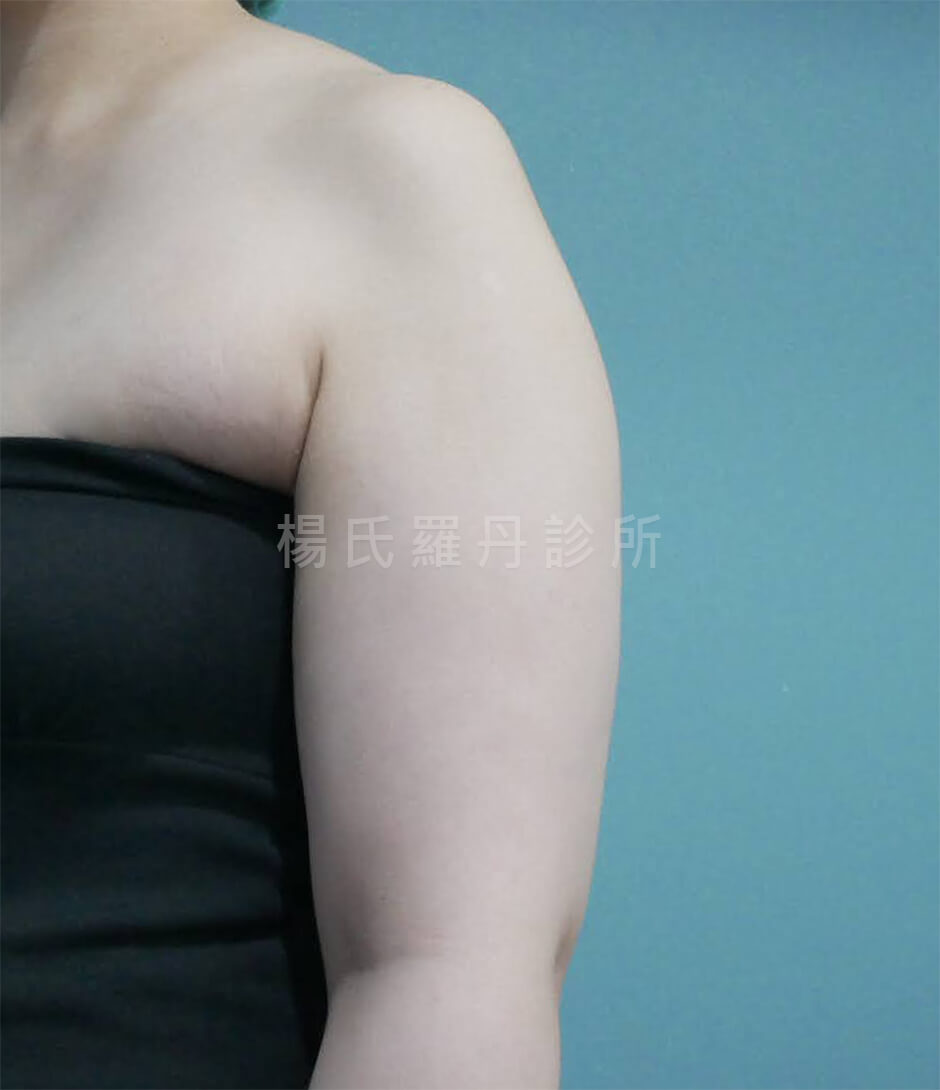 手臂抽脂 抽脂