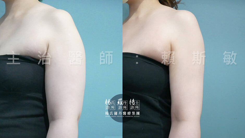 手臂抽脂 雷射減脂 抽脂