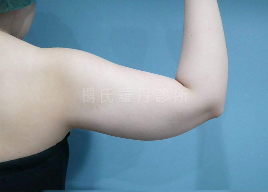 手臂抽脂 瘦手臂
