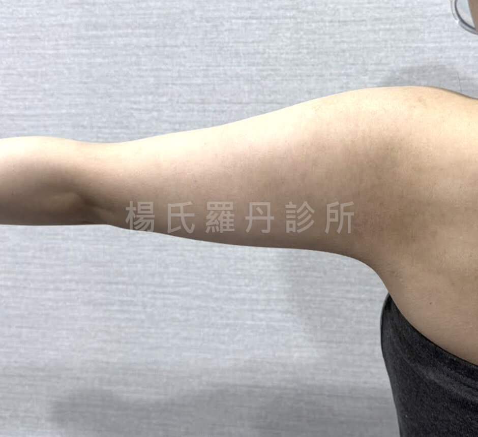 減脂手術 瘦手臂