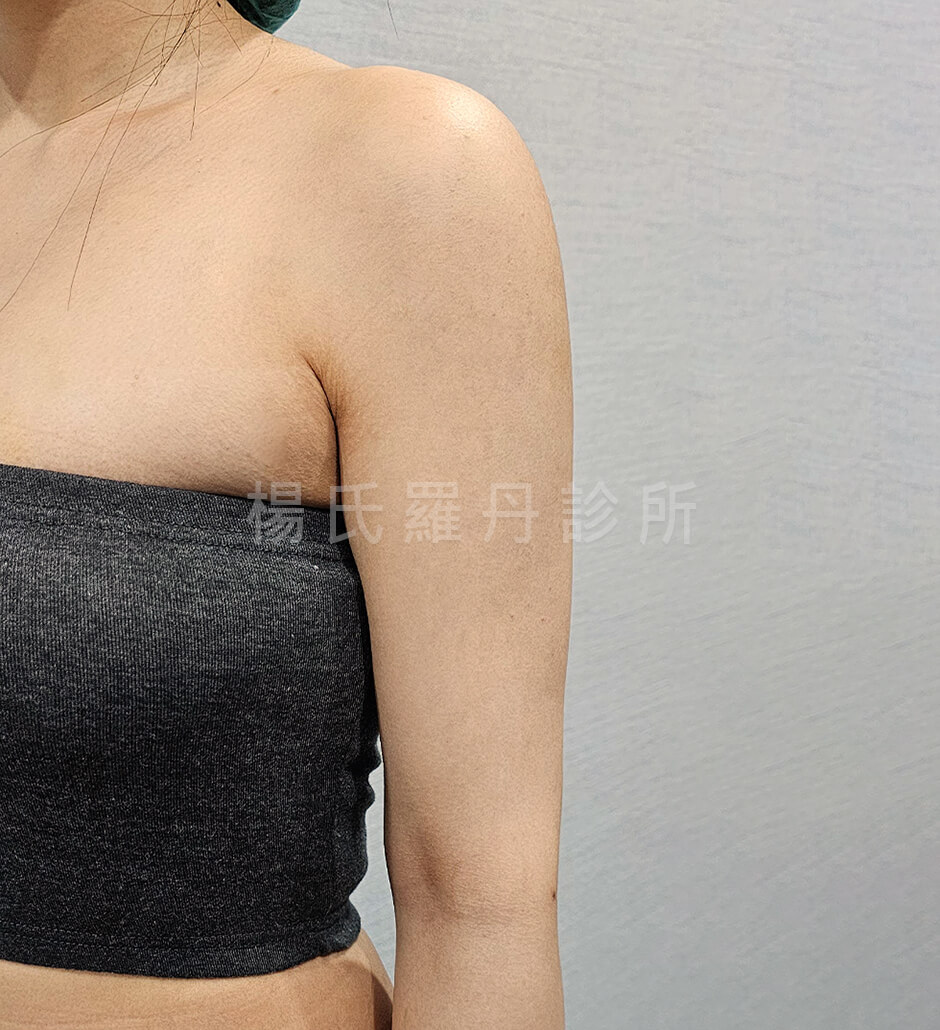 抽脂 手臂抽脂