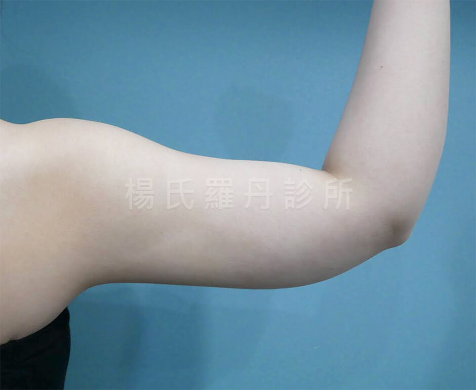 手臂抽脂 掰掰肉