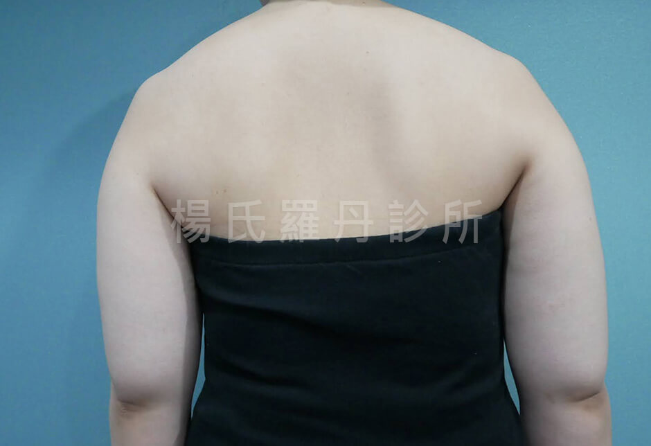 減脂手術 雷射減脂