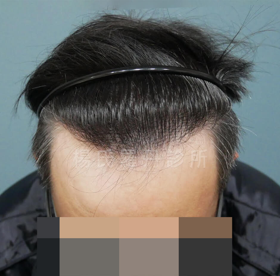 植髮 落髮
