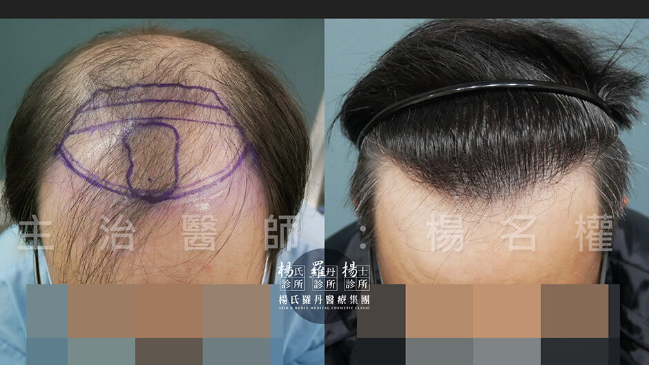 植髮 植髮手術 楊氏羅丹