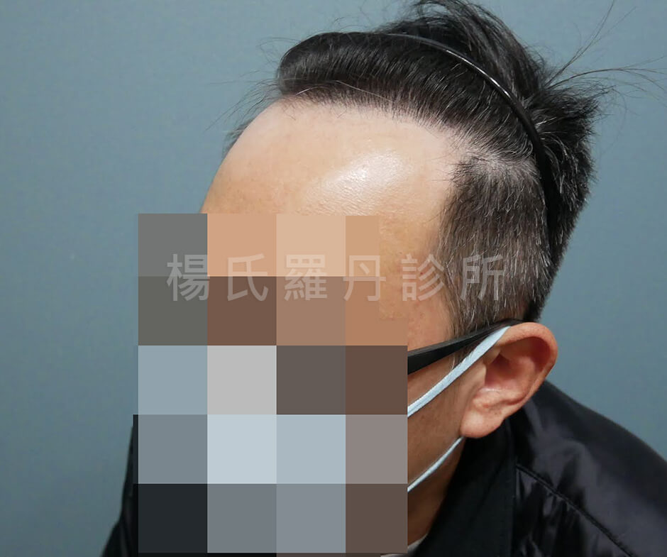 植髮 植髮效果