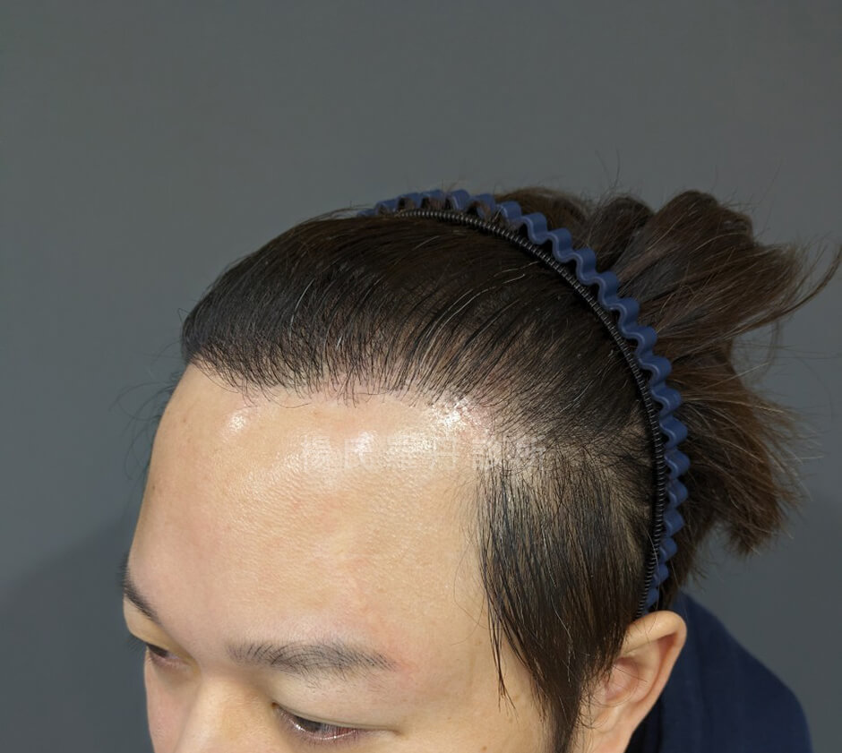 植髮 髮際線植髮