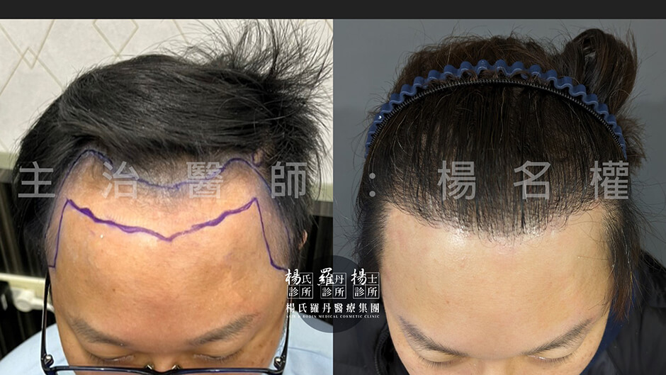 植髮 植髮效果 楊氏羅丹